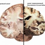Методы лечения деменции после перенесенного инсульта, причины возникновения, симптомы и прогноз