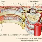 Межрёберная невралгия