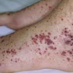 Fulminant type of vasculitis