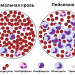 Можно ли вылечить лейкемию, и как этого добиться…