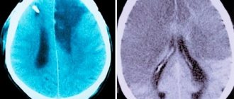 MRI