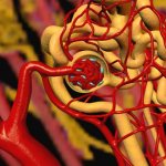 Нефрогенная артериальная гипертензия