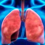 Непосредственные причины лёгочных кровотечений