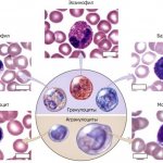 Незрелые гранулоциты повышены у взрослого: причины, норма у женщин, мужчин