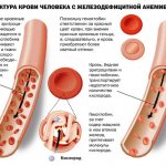 Низкий гемоглобин у женщин: причины, симптомы и последствия. Лечение пониженного уровня гемоглобина