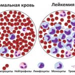 Норма лейкоцитов в крови у мужчин после 60
