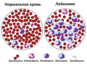 Норма лейкоцитов в крови у мужчин после 60