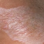 очаговая каплевидная склеродермия