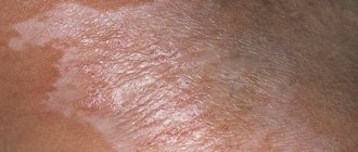 очаговая каплевидная склеродермия