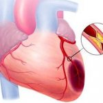 Очаговый инфаркт миокарда последствия