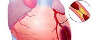 Очаговый инфаркт миокарда последствия