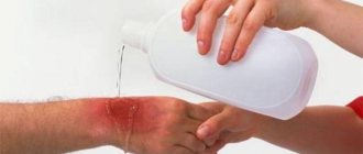 Охлаждение места ожога водой