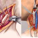 Операционный разрез в области сонной артерии