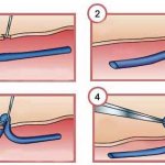 операция флебэктомия