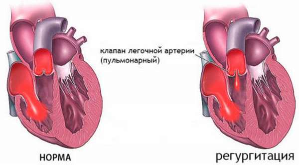 Особенности и оценка опасности для здоровья при регургитации на клапане легочной артерии 1 степени