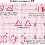 Острый инфаркт миокарда на ЭКГ