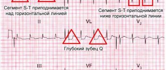 Острый инфаркт миокарда на ЭКГ