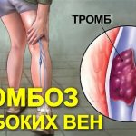 Острый тромбофлебит подкожных вен