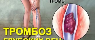 Острый тромбофлебит подкожных вен