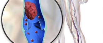 Acute thrombosis during pregnancy is an indication for mandatory hospitalization of a woman.