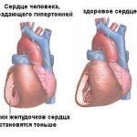 Отличительные черты гипертонии