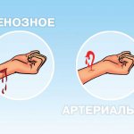 Отличия артериального и венозного кровотечения