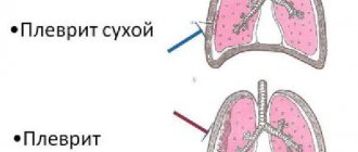 Pleurisy (dry)