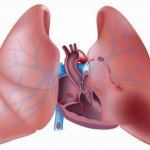 Почему может оторваться тромб, первые признаки, симптомы и последствия такого состояния
