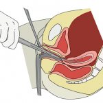 Почему после выскабливания болит поясница