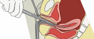 Почему после выскабливания болит поясница