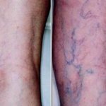 Почему появляются синие вены на ногах и как их лечить?