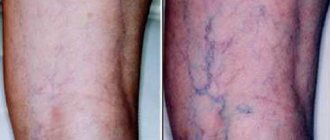 Why do blue veins appear on the legs and how to treat them?