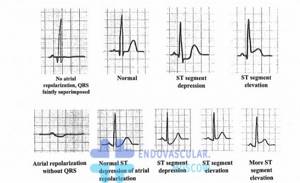 ECG for myocardial infarction (photo with transcript), cardiogram ...