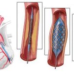 Положена ли группа инвалидности после операции шунтирования на сердце