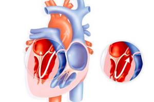 Порок сердца – всегда ли нужна операция?