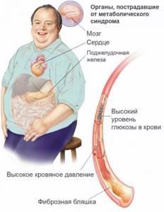 последствия ожирения2