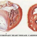 Постинфарктный крупноочаговый кардиосклероз