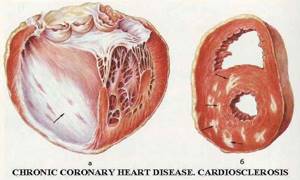 Постинфарктный крупноочаговый кардиосклероз