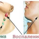 При заболевании увеличиваются узлы