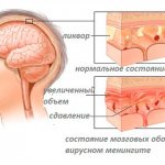 Причины гидроцефалии головного мозга