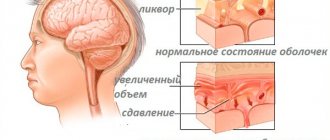 Причины гидроцефалии головного мозга