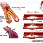 причины стенокардии