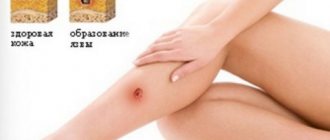 Example of ulceration