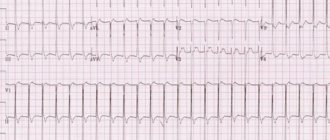 Пример пленки с тахикардией
