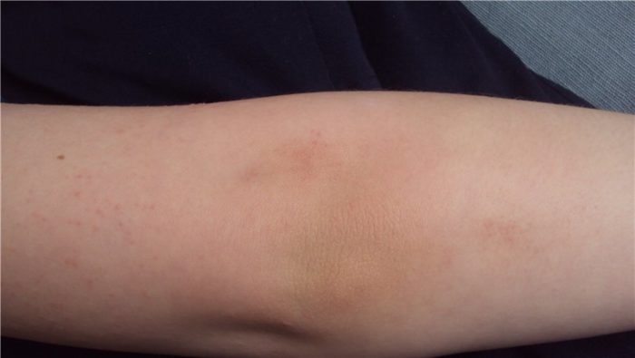 Пример заболевания на руке