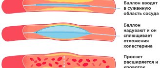 Принцип балонной ангиопластики