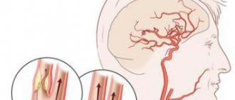 signs of angiodystonia of cerebral vessels