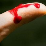 Признаки капиллярного кровотечения, первая помощь