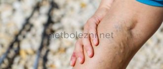 Проблемы с венами на ногах
