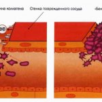 Процесс образование тромба в сосуде